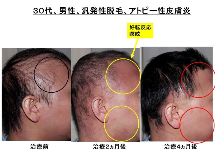 円形脱毛症　病院